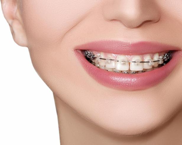 Smile Transformations: Navigating the Latest Orthodontic Trends for Straighter Teeth